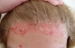 Применение средства Анолит Топ Форте (Анолит нейтральный) в лечении псориаза