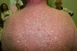 Применение средства Анолит Топ Форте (Анолит нейтральный) в лечении псориаза